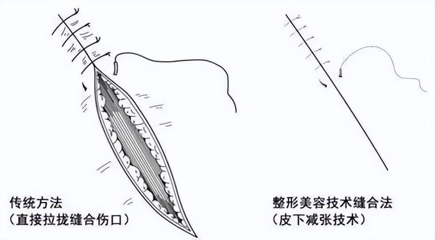 最新缝针疤痕，了解、管理与修复方法