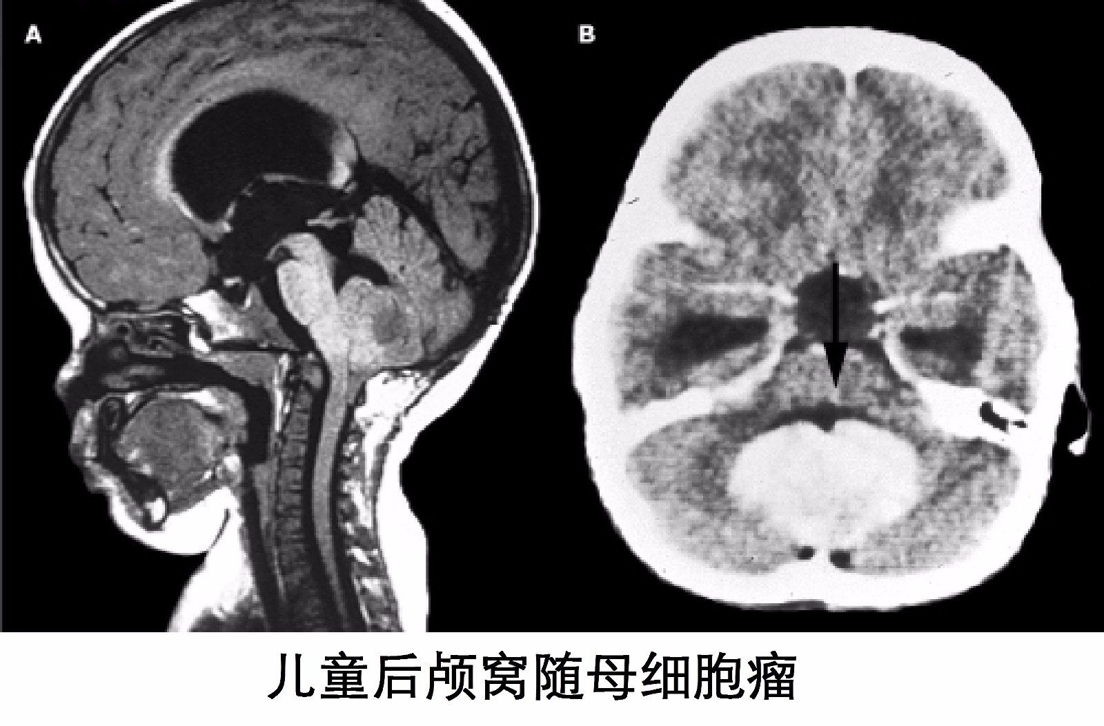 髓母细胞瘤最新治疗进展概览